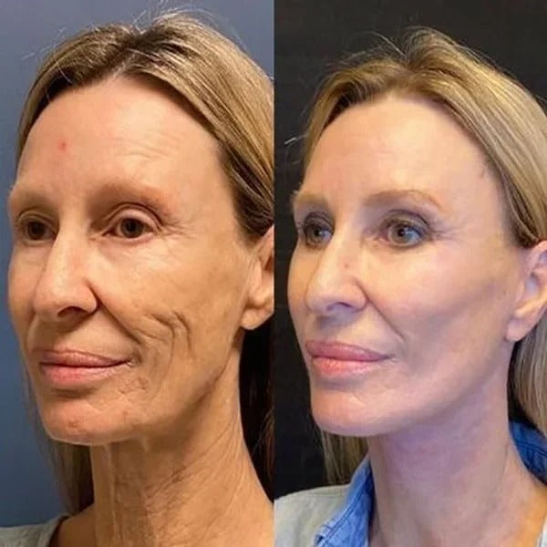 FirmSkin™ | Botox Ansigtsserum