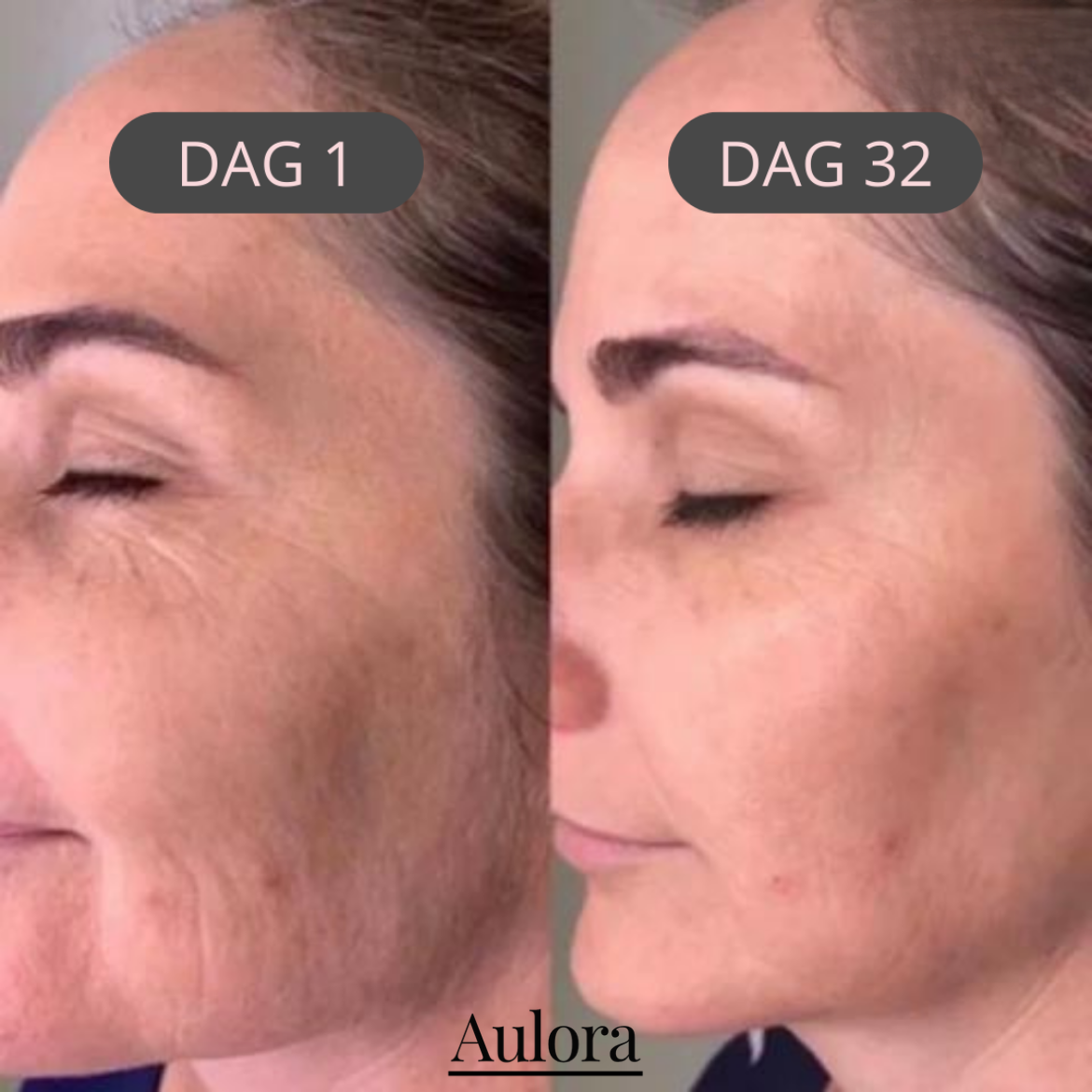 Lumilift- Face Lifting