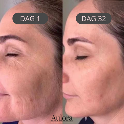Lumilift- Face Lifting