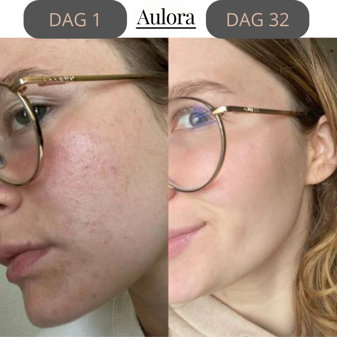 Lumilift- Face Lifting