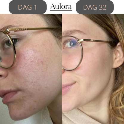 Lumilift- Face Lifting