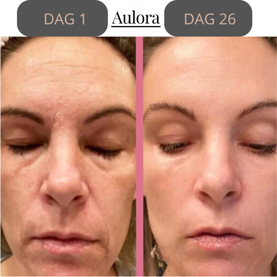 Lumilift- Face Lifting