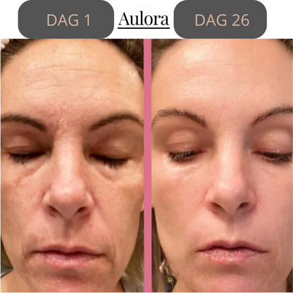 Lumilift- Face Lifting
