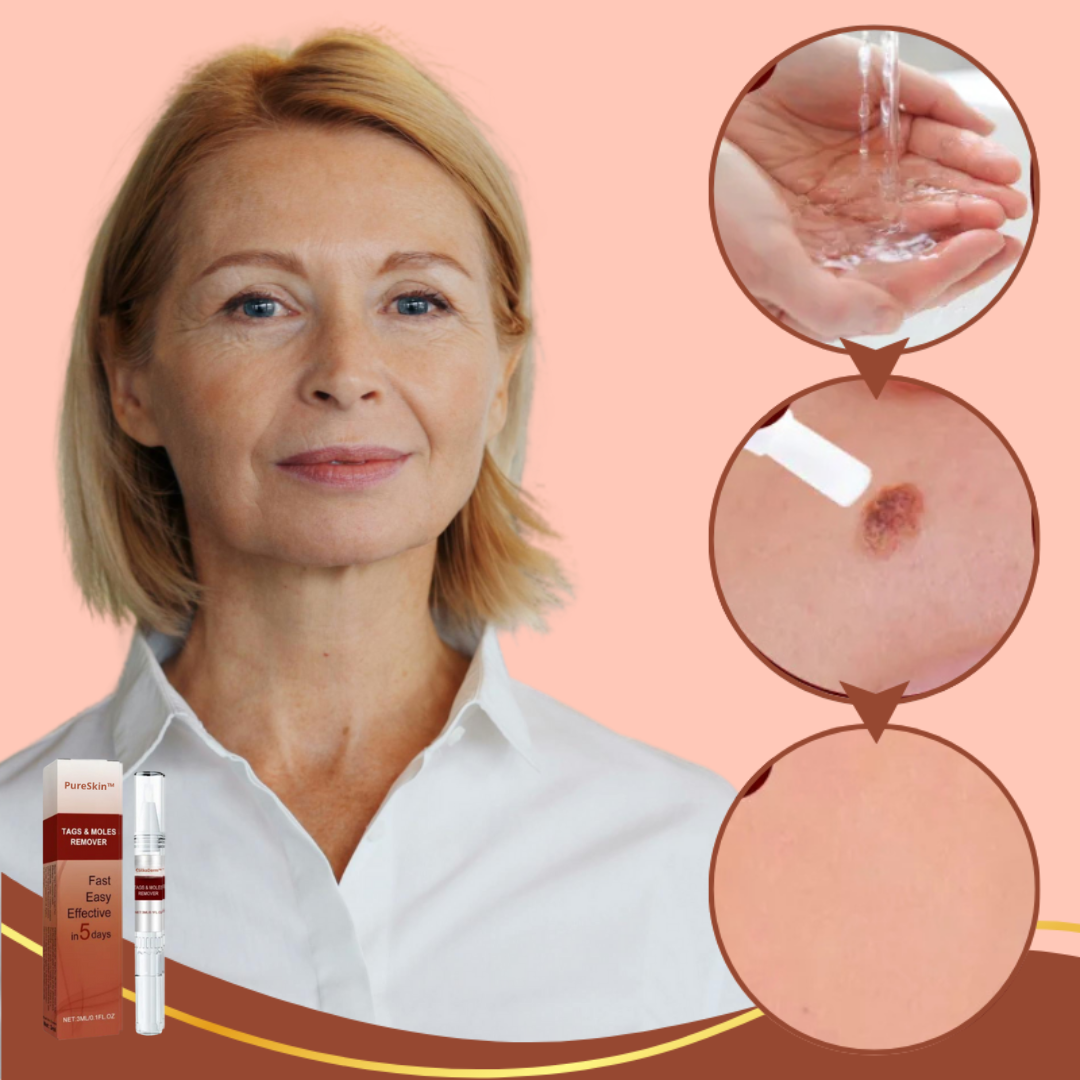 PureSkin™ | Fjerner vorter og alderspletter – smertefrit inden for 3 dage!