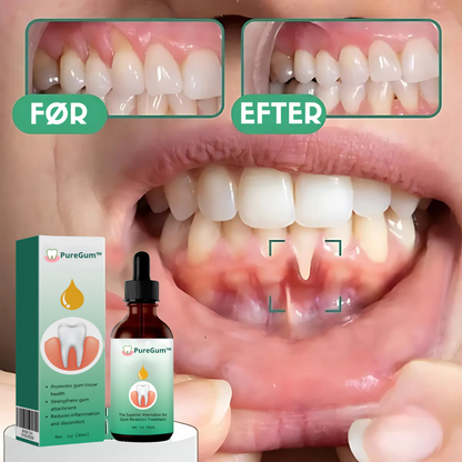 PureGum™ | Gendanner Vigende Tandkød I 100% Af Tilfældene Inden For 4 Dage!